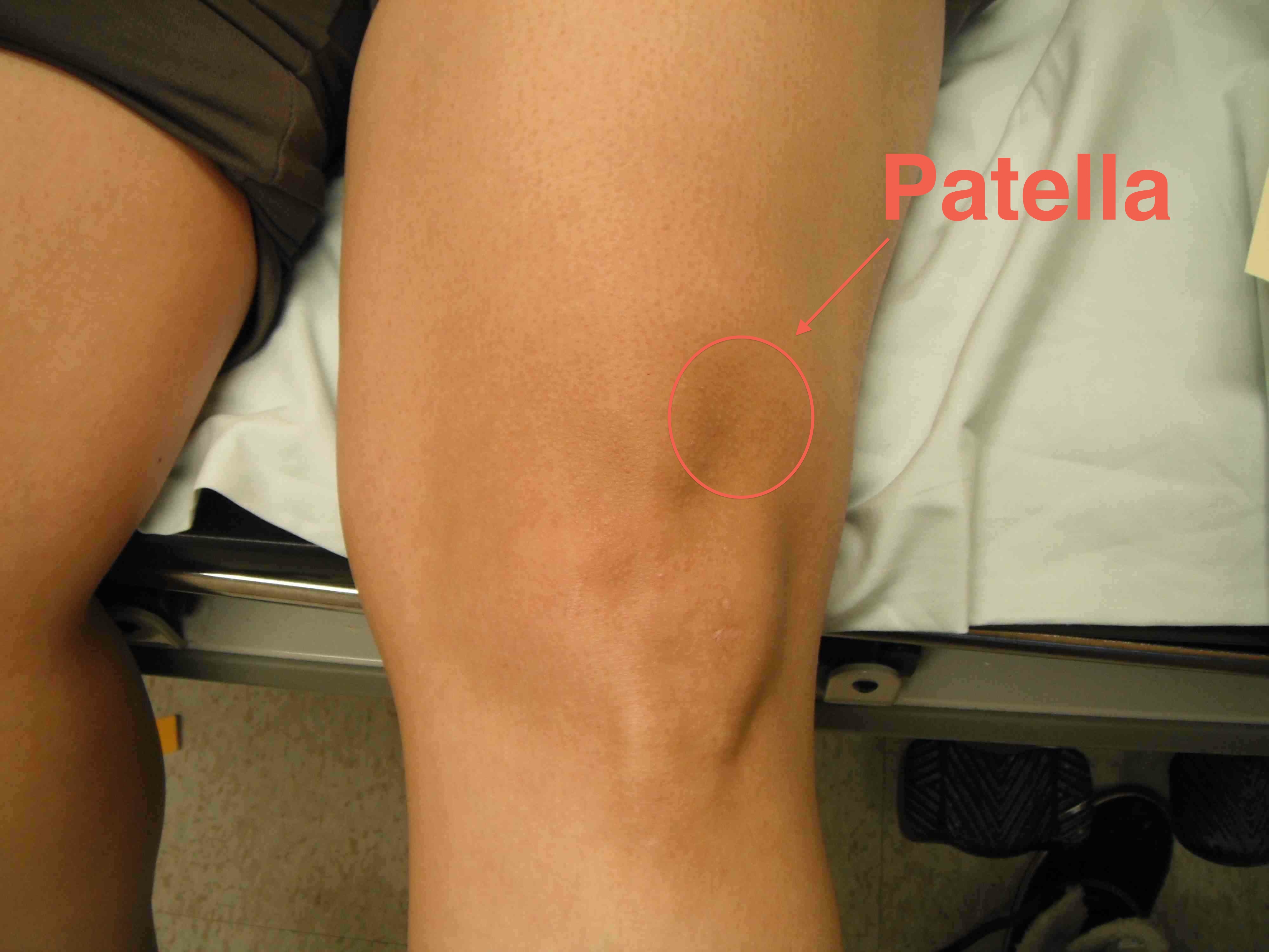 Patella J Tracking Extension